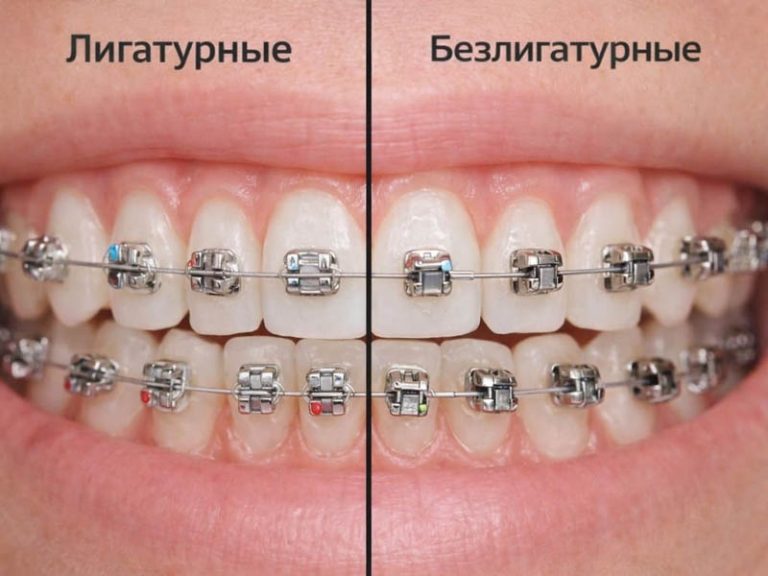 лигатурные брекеты