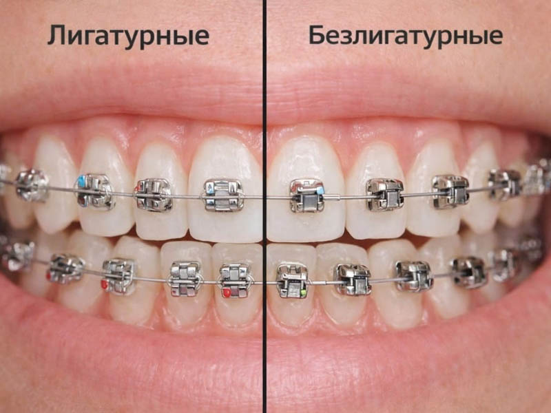 лигатурные брекеты